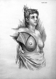 A sketch of the radical mastectomy from William Stewart Halsted Surgical Papers